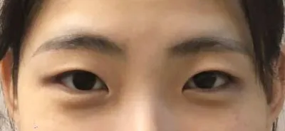 Энэ оны 4 сарын 20-нд нүдний хагалгаа (анхны), давхраа (байгалийн наалдац) болон нүдний хэлбэр засах (зүсэлтгүй) аргаар давхрааны хагалгаа хийлгэсэн.