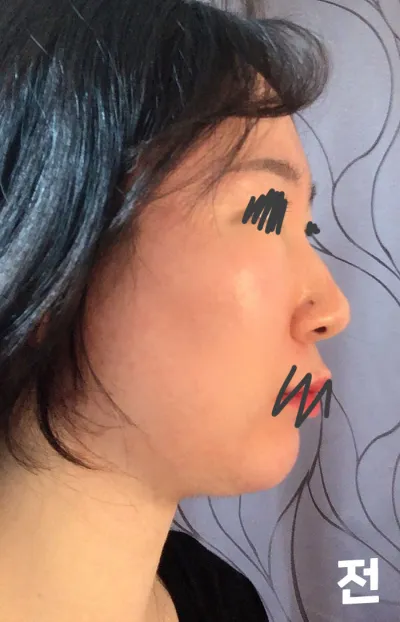 Very Good гоо сайхны эмнэлэгт хамрын өндөрлөгөө, яс хугалах, доод самалхай, хамрын нурууны товгор засах, хамрын угалз нарийсгах хагалгаа хийлгээд 7 сар болж байна!