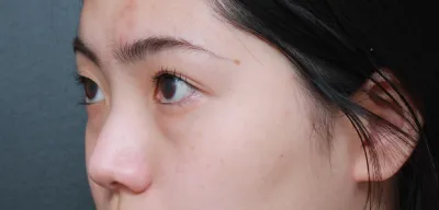 Very Good гоо сайхны эмнэлэгт хамрын хагалгаа (анхны), хамрын өндөрлөгөө, яс хугалах, нүдний доорх өөх шилжүүлэн байрлуулах хагалгаа хийлгэсэн!