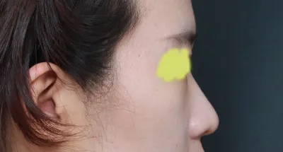 Анхны хамрын хагалгааны сэтгэгдлээ үлдээж байна~