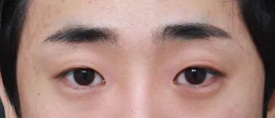 Нүд маань нойрмог харагдаж, сормуус нүд рүү ороод байсан болохоор хагалгаа хийлгэхээр шийдсэн.