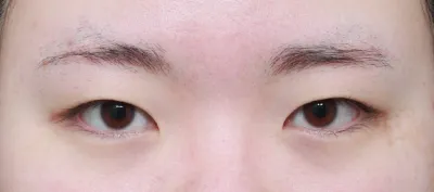 Давхраагүй байсан би энэ удаад нүдний хагалгаа (анхны) хийлгэлээ..