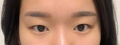 Давхраатай том нүдтэй болохыг маш их хүссэн учраас давхрааны хагалгаа хийлгэсэн!