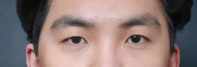 Эрэгтэй нүдний хагалгаа, одоо өөртөө итгэлтэй болсон хх