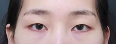 Өмнө нь хагалгаа хийлгэх эсэхдээ их эргэлзэж байсан ч хийлгэсэн маань үнэхээр зөв болжээ!