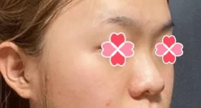 Хамрын хагалгааны дараа төрх маань ерөнхийдөө илүү дээрдсэн гэж их сонсож байна хх