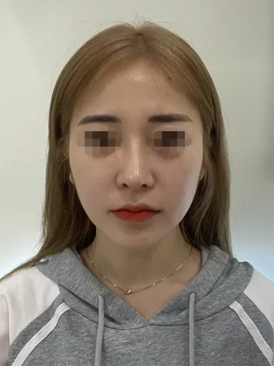 Нүүрний хэлбэр жаахан дутуу санагдаад нүүрэндээ бүтэн өөх шилжүүлэн суулгах хагалгаа хийлгэсэн!