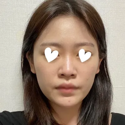 Ганцхан хамрын хагалгаагаар төрх маань өөрчлөгдсөнд сэтгэл хангалуун байна ❤️