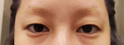 Байгалийн наалдац аргаар давхраа хийлгээд сар гаруй болж байна~