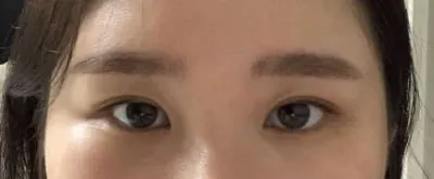 Дуал кантопластик (нүд томсгох) хийлгээд маш их сэтгэл хангалуун байна.