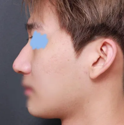 Very Good гоо сайхны эмнэлэгт хамрын хагалгаа хийлгээд нэг сар болсон сэтгэгдэл байна!