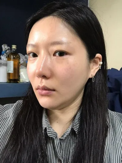 30 гарсан ч залуухан харагдаж байна гэж сонсоход лифтинг (арьс татах) үйлчилгээ үнэхээр сайн нөлөөлсөн бололтой.