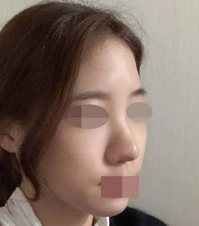 Зөвхөн хамрын филлер хийлгэдэг эсвэл хамрын хагалгаа хийлгэх үү гэж эргэлзэж байгаа хүмүүс битгий эргэлзээрэй, хагалгаа хийлгэхийг зөвлөж байна! Им захирлыг үнэхээр их санал болгож байна!!