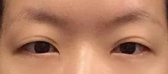 Сайн байна уу. Хагалгаа хийлгээд аль хэдийн 6 сар өнгөрчээ.