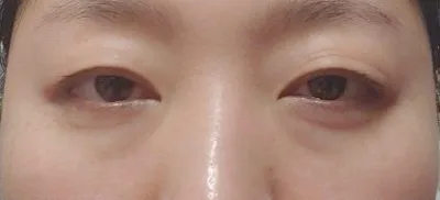 Нүдний доорх өөх шилжүүлэн суулгах хагалгаанд ороод аль хэдийн 3 сар гаруй болжээ.