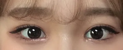 "Very Good" гоо сайхны эмнэлэгт байгалийн наалдац болон нүдний дотор булан нээх хагалгаа хийлгэсэн!