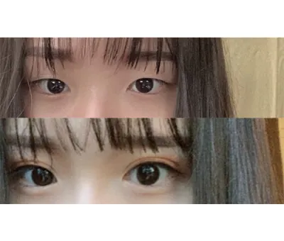 Хагалгааны өмнө нүдний үрчлээндээ санаа зовж байсан ч яг хүссэнээр минь боллоо.