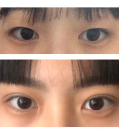 Хагалгааны дараах зураг бол давхраа хийлгээд 38 хоног орчим болсон нүд юм!