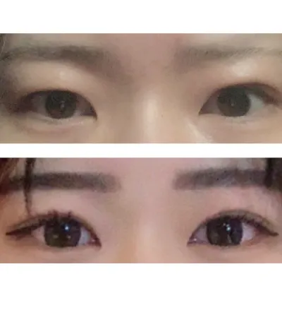 Давхрааны хагалгаа хийлгээд одоо маш их таалагдаж байгаа болохоор энэ постыг оруулж байна.