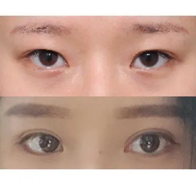 Өмнө нь зүсэлттэй давхраа хийлгэсний дараа давхраа маань улам бүдгэрч орсоор байсан нь стресс болдог байсан тул дахин хагалгаа хийлгэхээр сонгосон.