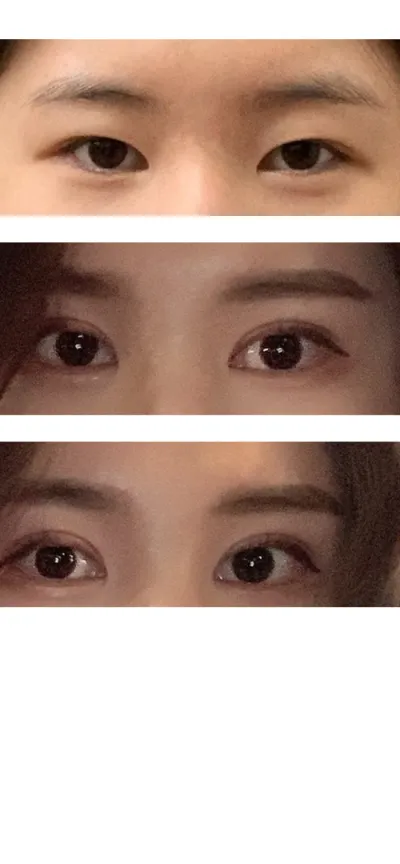 Давхраа зүсэлттэй дахин хагалгаа, нүдний гадна болон доод өнцөг нээх (dual canthoplasty), зүсэлттэй нүдний хэлбэр засах хагалгааны сэтгэгдэл.