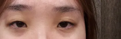 Very Good гоо сайхны эмнэлэгт анхны нүдний хагалгаагаа хийлгэлээ.