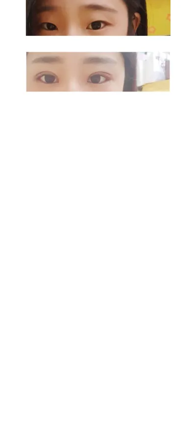 Би давхраа, байгалийн наалдац, нүдний дотор болон гадна өнцөг нээх хагалгаа хийлгэсэн~~^^