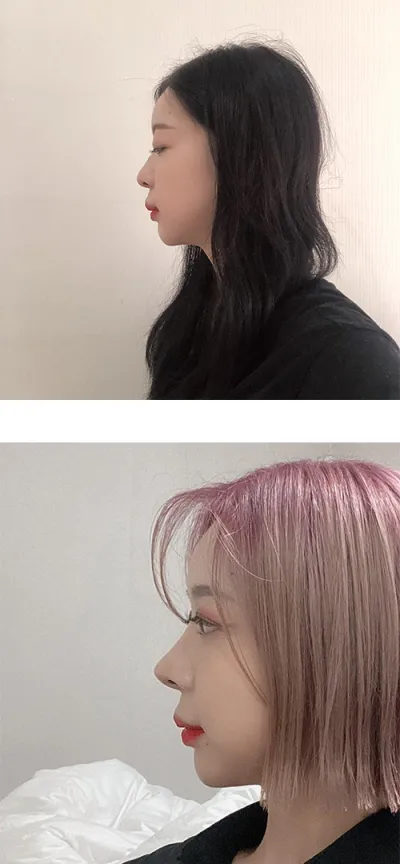 Хамрын хагалгааны 6 сарын дараах сэтгэгдэл байна.