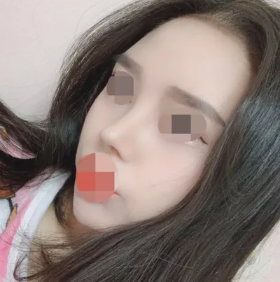 Анхны хамрын хагалгаа, хамрын нуруу, хамрын үзүүр, богино хамар, хамрын угалз багасгах хагалгаа хийлгэсэн.