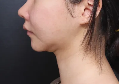 Оёдол болон хагалгааны дараах арчилгааг нэг бүрчлэн нямбай хийж өгсөн. Өөх соруулахад буцаж таргалах асуу