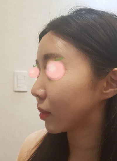 Өөрийн хавирганы мөгөөрсөөр хамрын мэс засал хийлгэсэн, одоо маш сэтгэл хангалуун байна хххх