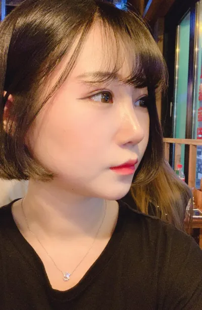 Анхны нүд, нүдний хэлбэр засах, урд зүсэлт, хос зүсэлт, хамрын нуруу, үзүүр, хамрын төвгөр засах хагалгаандаа маш их сэтгэл хангалуун байна.