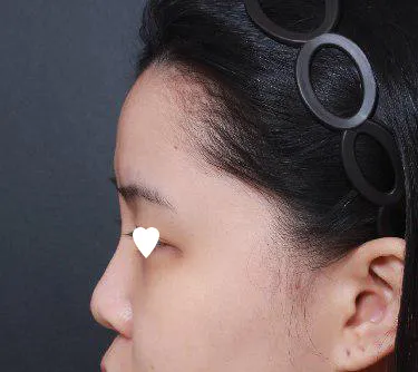 Им Ён Мин эмчээр хамрын хагалгаа хийлгэлээ.