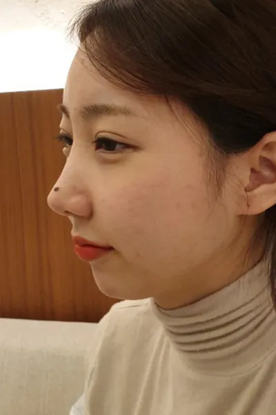 Эрүү дутуу байсан болохоор эрүүний үзүүр засах хагалгаа хийлгэсэн!!