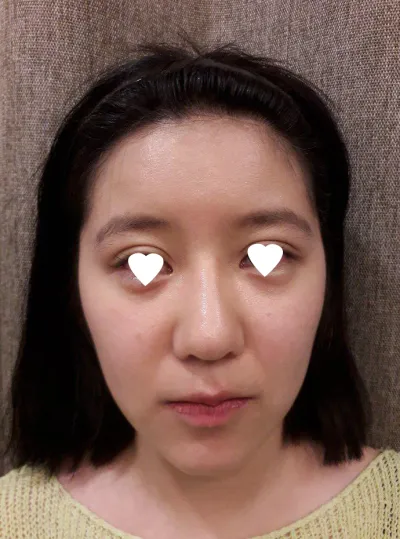 Шанаа, эрүүний урт шугам, эрүүний үзүүр, хамрын дахин хагалгаа хийлгэсэн.