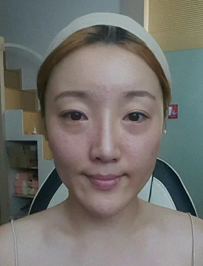 Давхраа, нүдний доорх өөх шилжүүлэх, нүүрний хэлбэр засах 3 төрлийн хагалгааны 3 сарын дараах сэтгэгдэл.