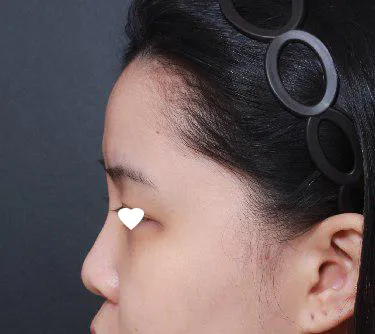 Very Good гоо сайхны эмнэлэгт Им Ён Мин эмчээр хамрын хагалгаа хийлгэлээ.