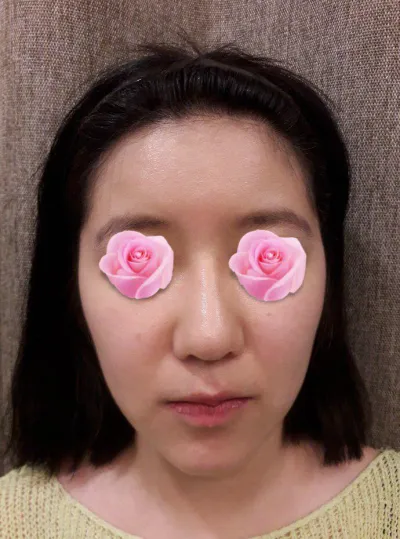 Хагалгаа хийлгээд 2 сар боллоо. Хамрын дахин хагалгаа, нүүрний хэлбэр засах, шанаа, эрүүний урт шугам, эрүүний үзүүр засуулсан.