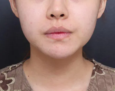 Нүүрний өөх соруулснаас хойш нэг сар орчим болж байна, нүүрний хэлбэр гоё гарч ирээд маш их сэтгэл хангалуун байна!