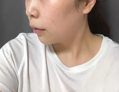 Давхар эрүү, эрүүний шугамын өөх соруулах хагалгааны нэг сарын дараах сэтгэгдэл~