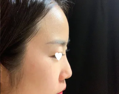 Эргэн тойрны хүмүүс бүгд хэлбэр нь гоё болсон байна гээд л шуугиж байна! Яг миний хүссэн хамрын үзүүрийн хэлбэр байна. Баярлалаа.