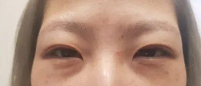 Ким Жүн Хён эмчээр зүсэлттэй давхрааны дахин хагалгаа хийлгэсэн~