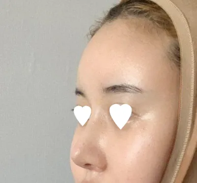 Им Ён Мин эмчээр хамрын дахин хагалгаа хийлгэсэн!!!