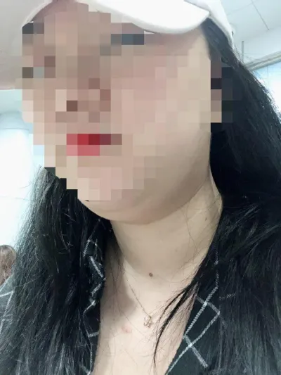 Давхар эрүүнээсээ болоод үргэлж санаа зовдог байж байгаад нүүрний өөх соруулах хагалгаа хийлгэсэн.