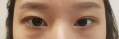 Хагалгаа хийлгээд бараг 3 сар болсны дараах зураг байна~~ Сэтгэгдлээ үлдээж байна!!~