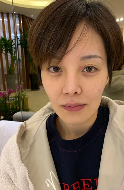 Эластикүм (Elasticum) хагалгаа хийлгээд 6 сарын дараах сэтгэгдэл!!