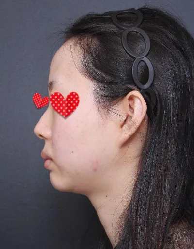 Хамар болон өөх шилжүүлэн суулгаад 3 долоо хонож байна. Өргөн хамар, шонхор хамар, хонхор дух, эрүүнээс болж авдаг байсан стресс бүрмөсөн арилсан.