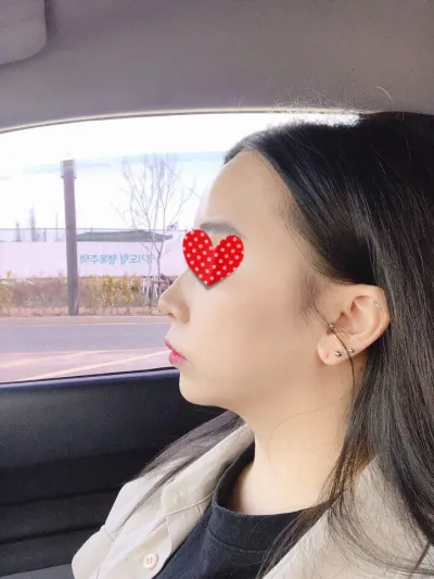 Very Good гоо сайхны эмнэлэгт 4 сарын 9-нд нүүрний бүтэн өөх шилжүүлэн суулгах хагалгаа хийлгэсэн~