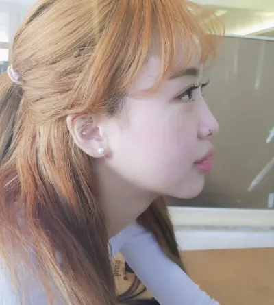 Давхраа, төрөлхийн наалдац, нүдний хэлбэр засах, нүдний дотор, гадна, доод өнцөг гаргах гээд бүгдийг нь хийлгэсэн!