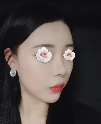 Им Ён Мин эмчээр хамрын хагалгаа хийлгээд нэг сар болж байна.